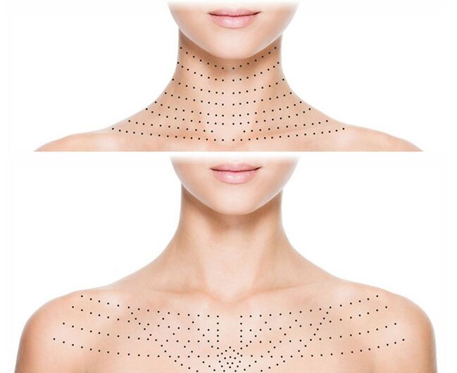 Marked on neck and chest skin for biorevitalization rejuvenation