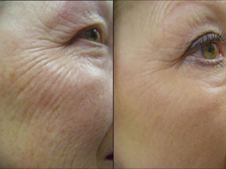 Before and after laser rejuvenation - significant wrinkle reduction