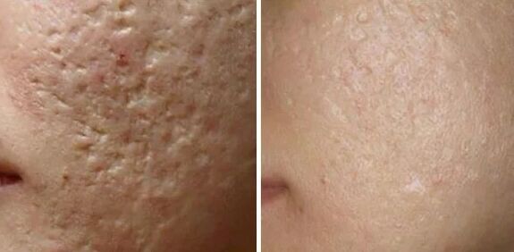 Scarring laser