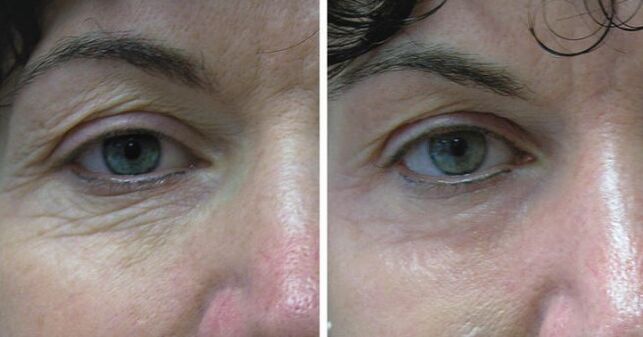 Laser skin around the eyes