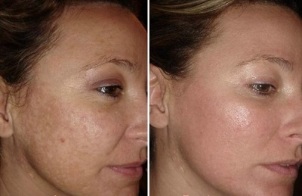 Laser facial rejuvenation before and after photo